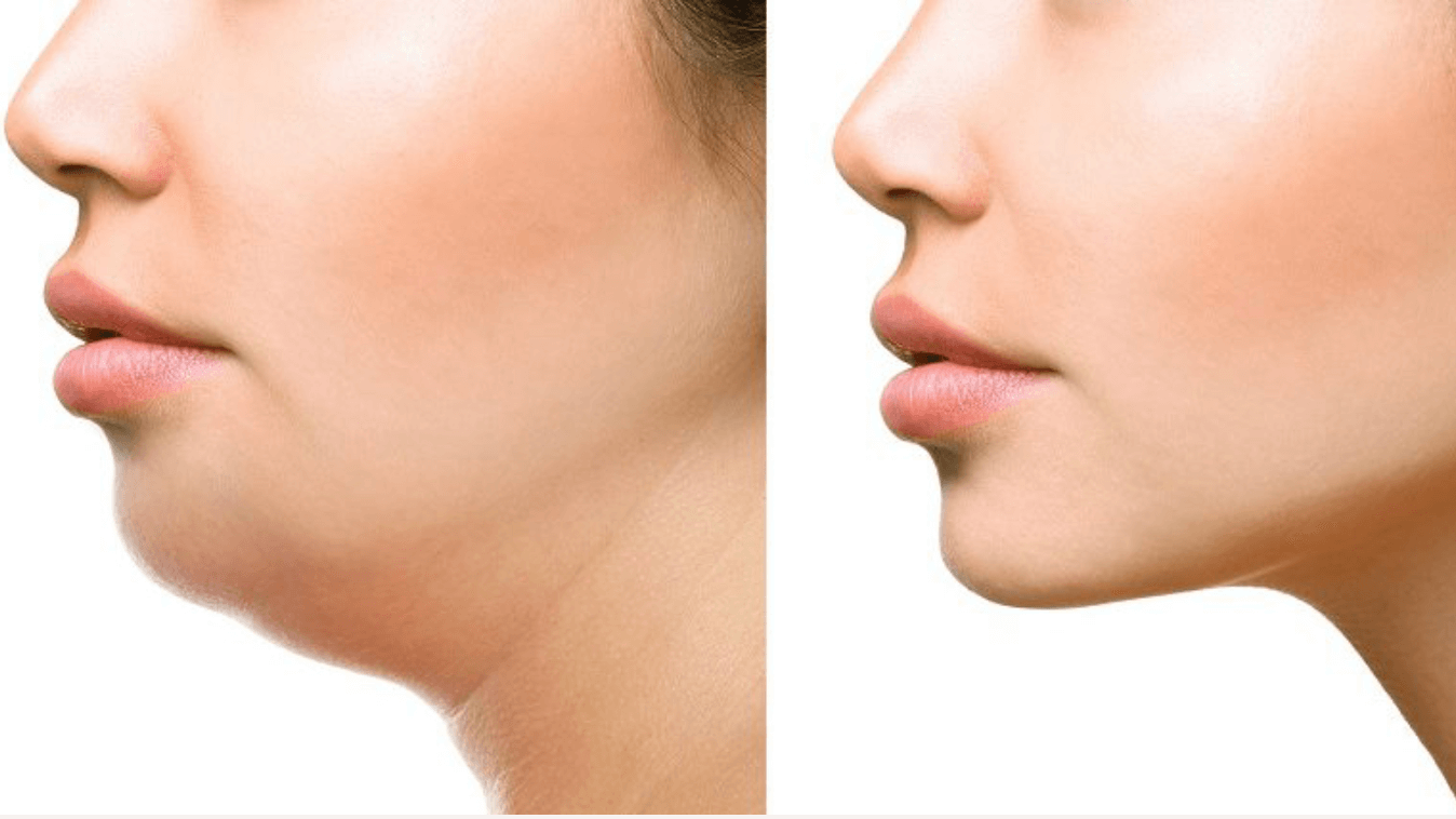 Neck Contour